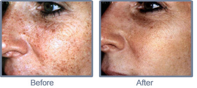 Photorejuvenation of aging skin