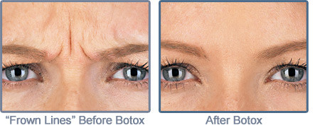 Frown Lines, Before and After Botox Treatment