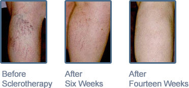 Leg Vein Treatment showing sclerotherapy results