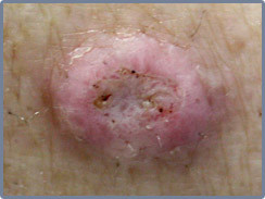 Squamous Cell Carcinoma -- close up