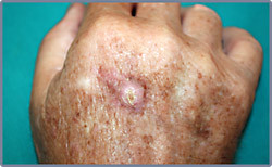 Squamous Cell Carcinoma on the back of the hand.